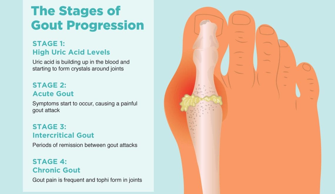 Stages of Gout Progression