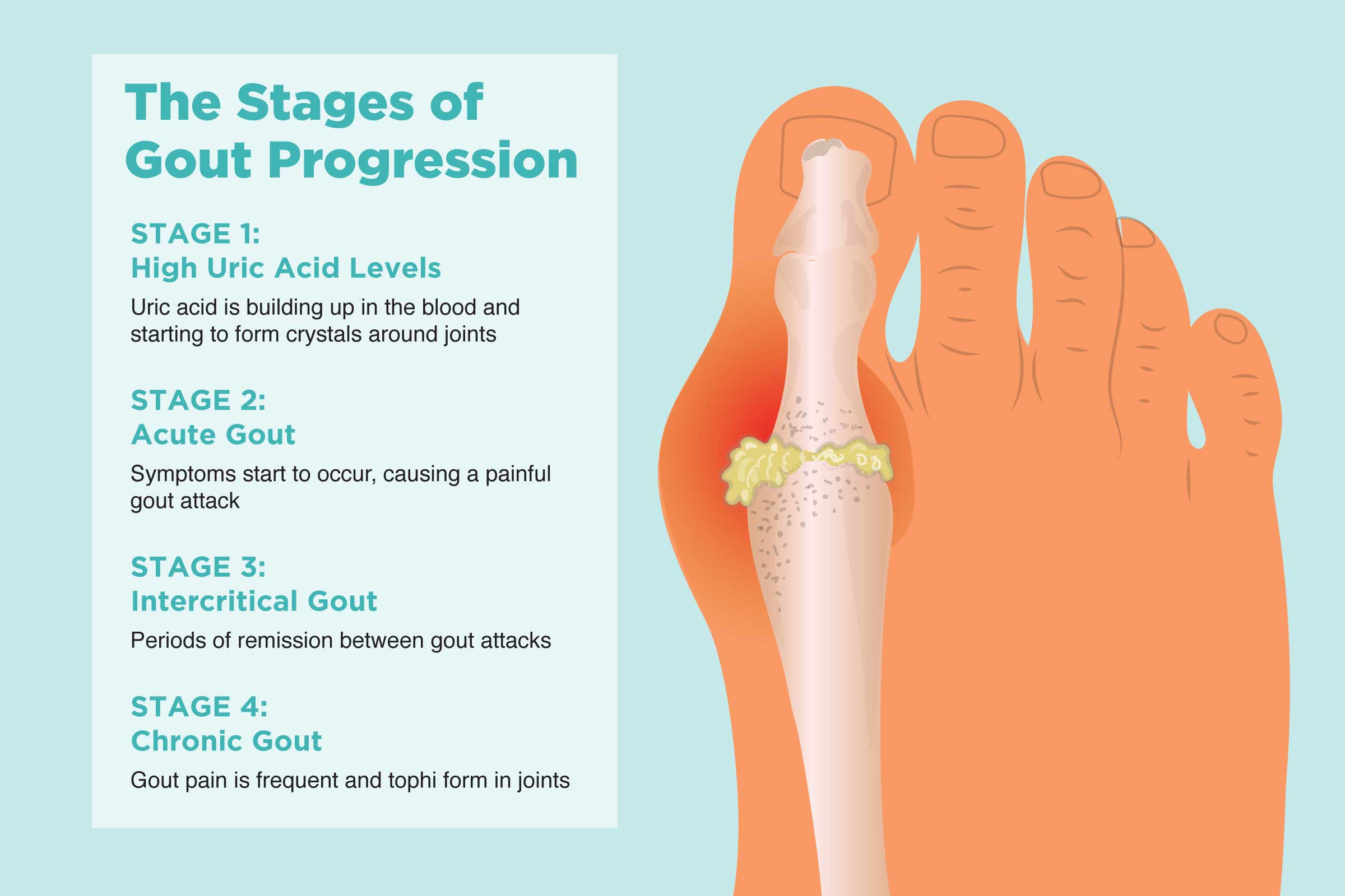 The 4 Stages of Gout Progression (and How to Stop Gout from Getting Worse)