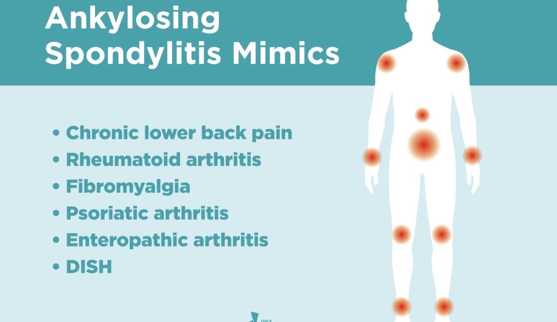 Ankylosing Spondylitis Misdiagnoses