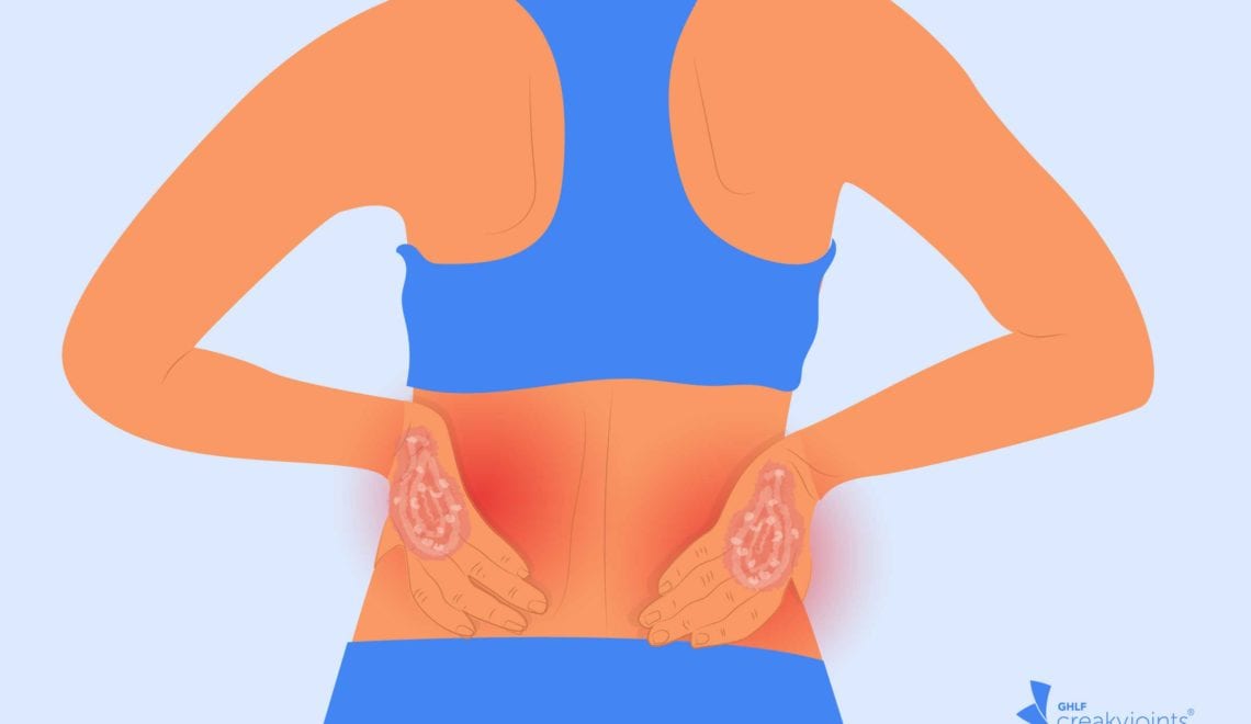 Ankylosing Spondylitis with Psoriasis vs. Psoriatic Arthritis with Back Pain