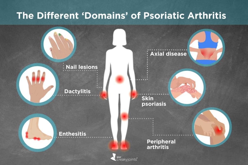 Different Types Of Psoriatic Arthritis Symptoms Treatments Outcomes   1019 Psoriatic Arthritis Types Logo 1024x683 