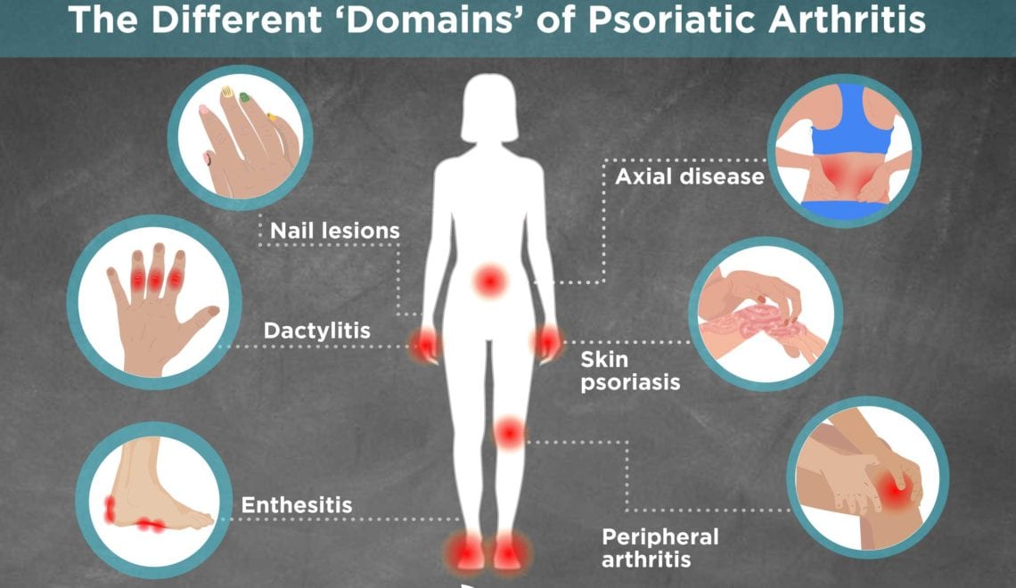 Types and Domains of Psoriatic Arthritis