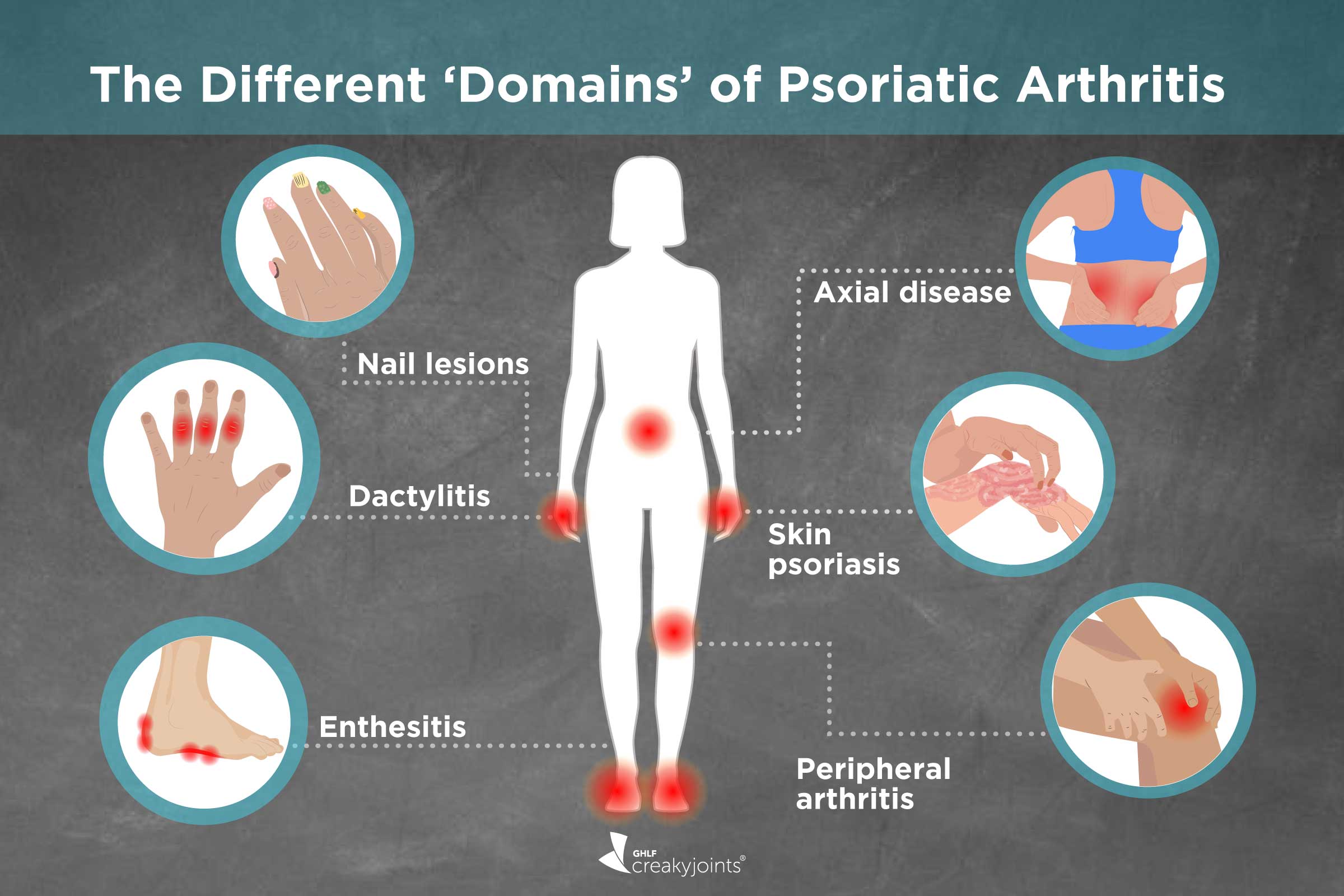 Different Types of Psoriatic Arthritis: Symptoms, Treatments, Outcomes