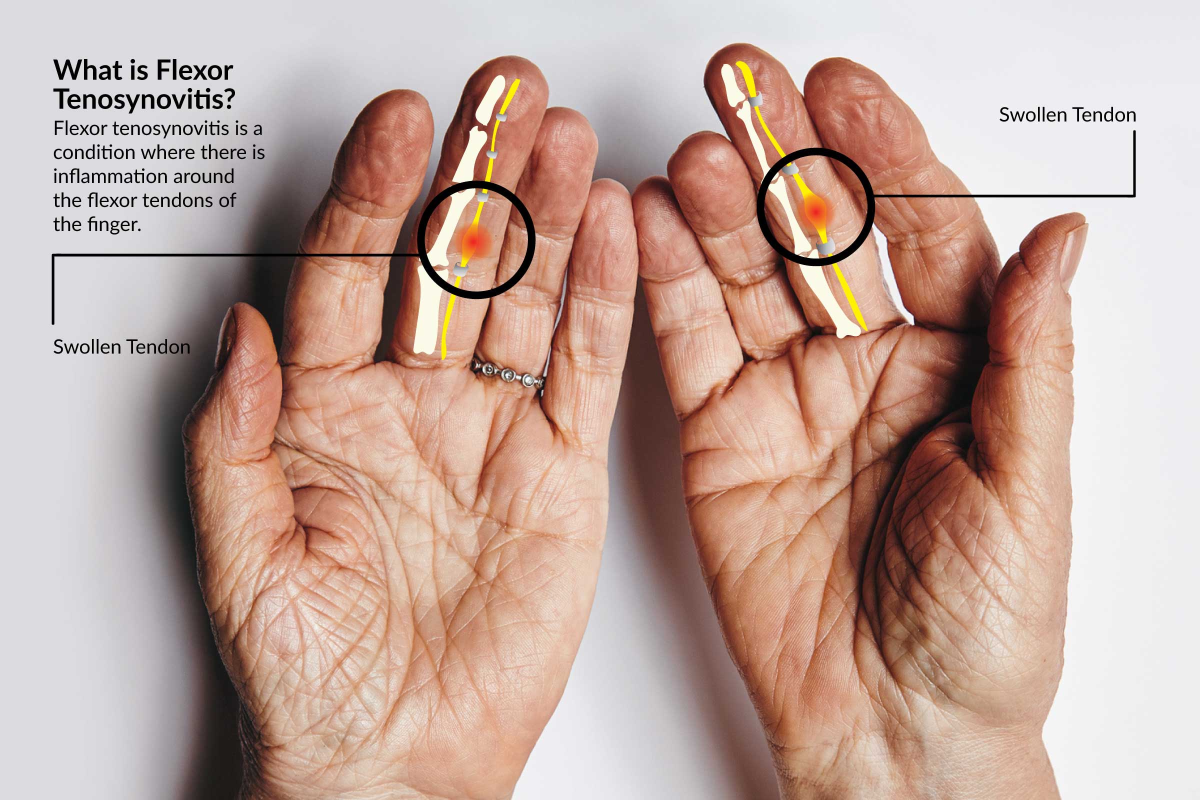 infectious-tenosynovitis