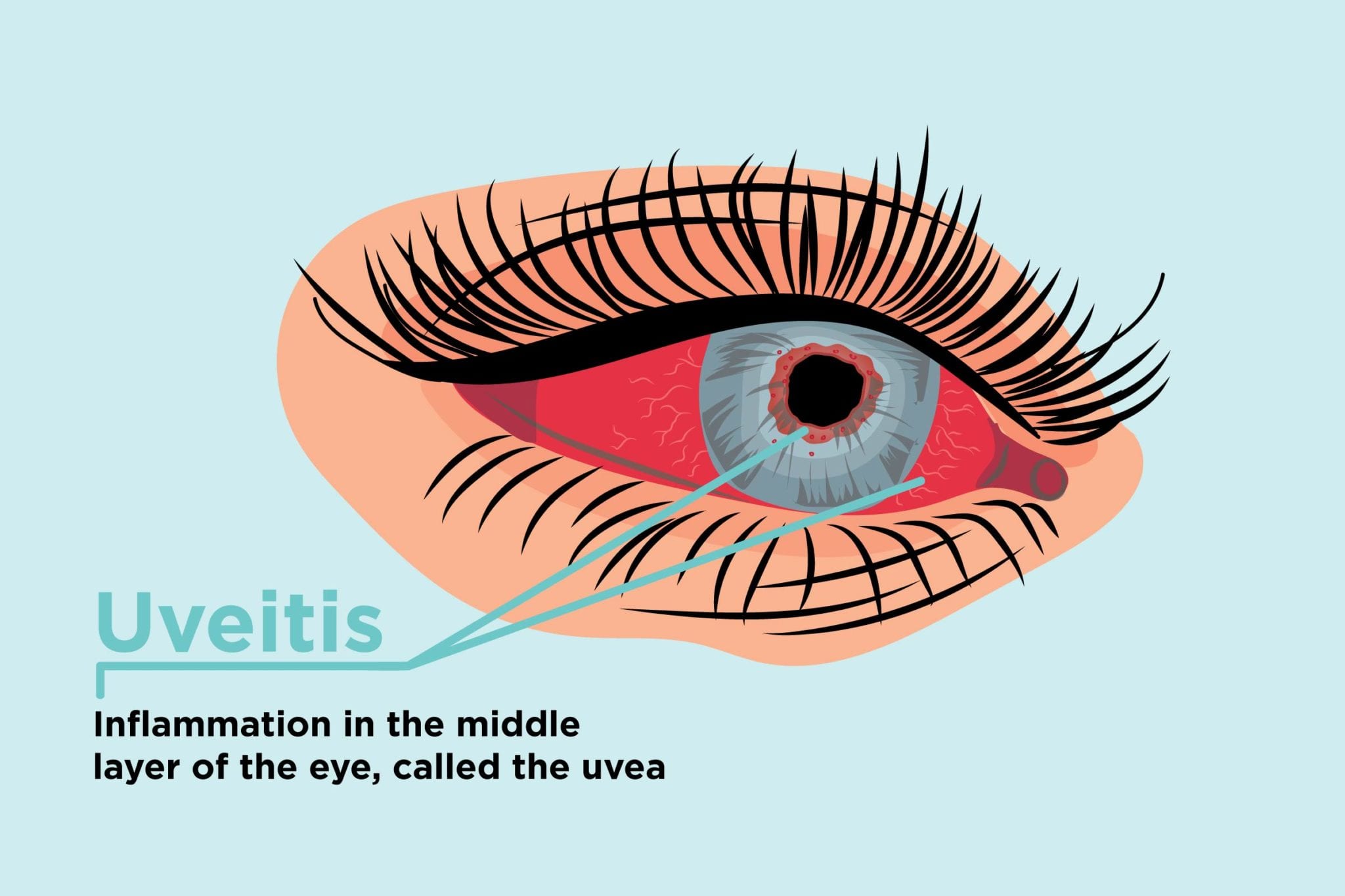 Eye inflammation deals types