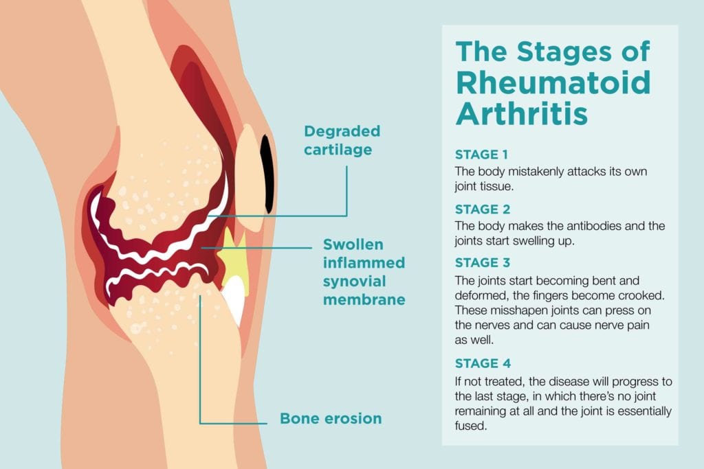 Knee Symptoms Chart