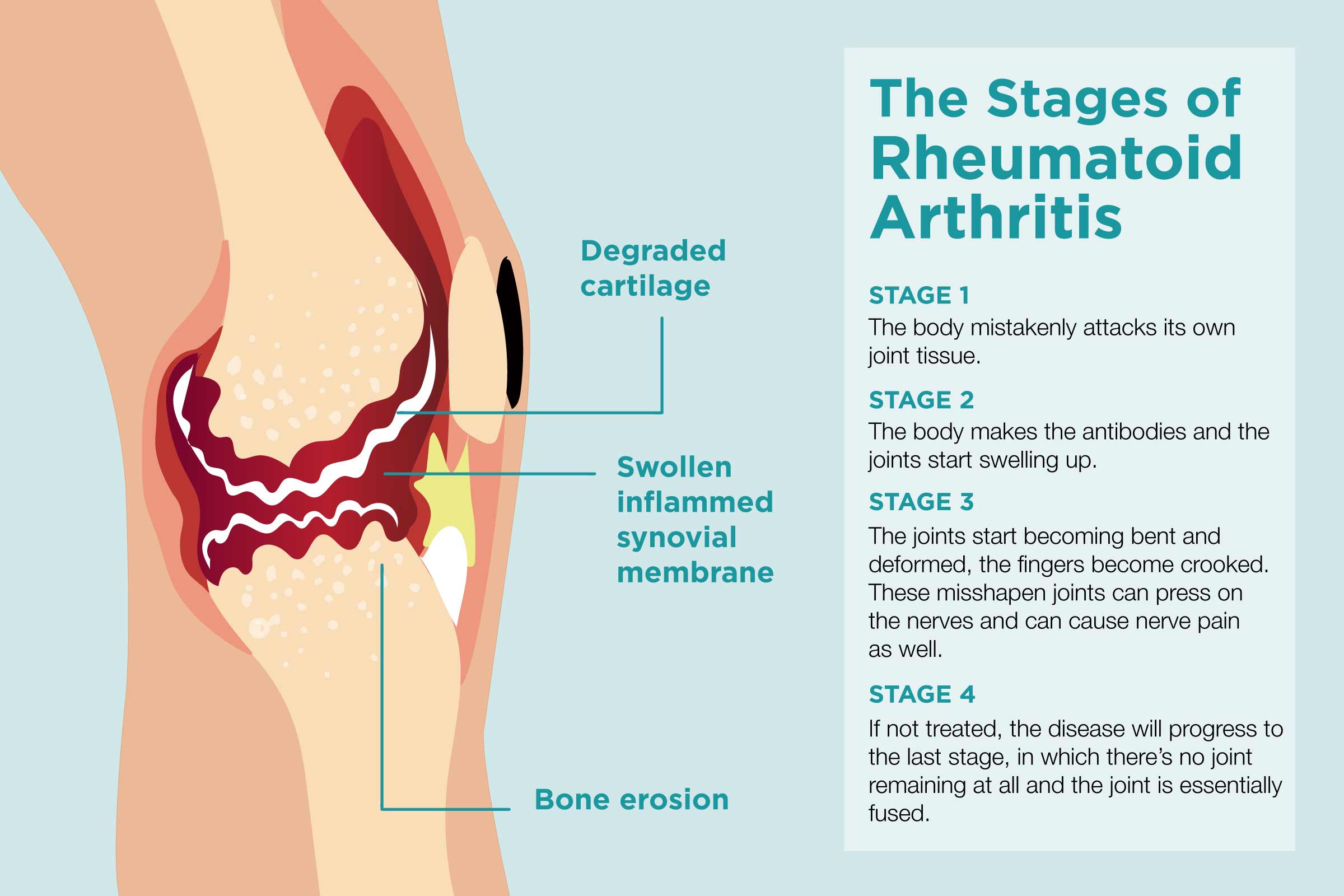 Rheumatoid Arthritis Disease Progression: Signs Rheumatoid