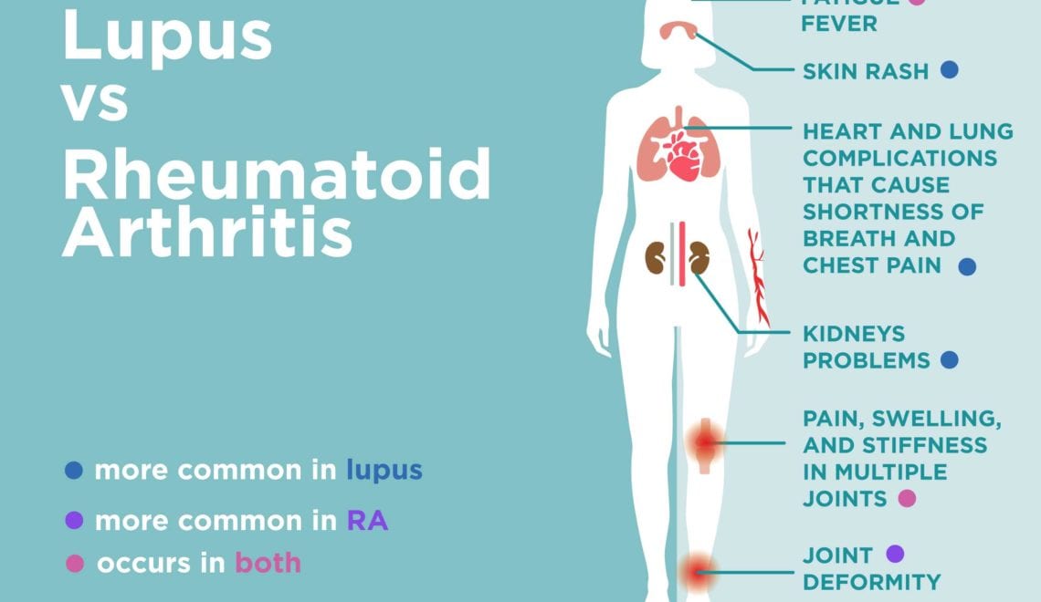 Rheumatoid arthritis stages - Evaluation of complex therapy in early stages of rheumatoid arthritis