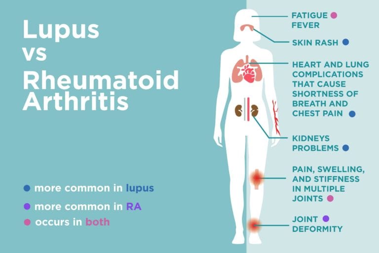 Lupus vs. Rheumatoid Arthritis: What’s the Difference? – CreakyJoints