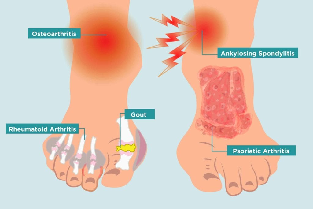 Arthritis in Your Feet: Causes 