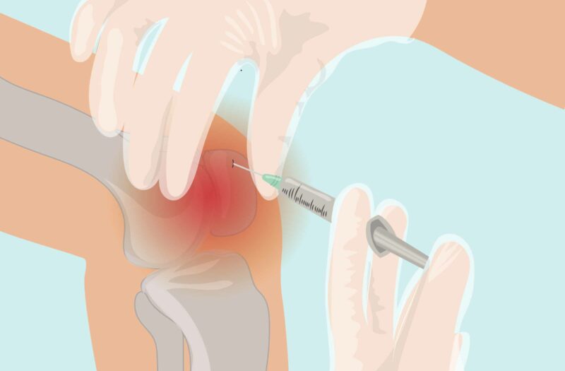 Cortisone Shots for Arthritis