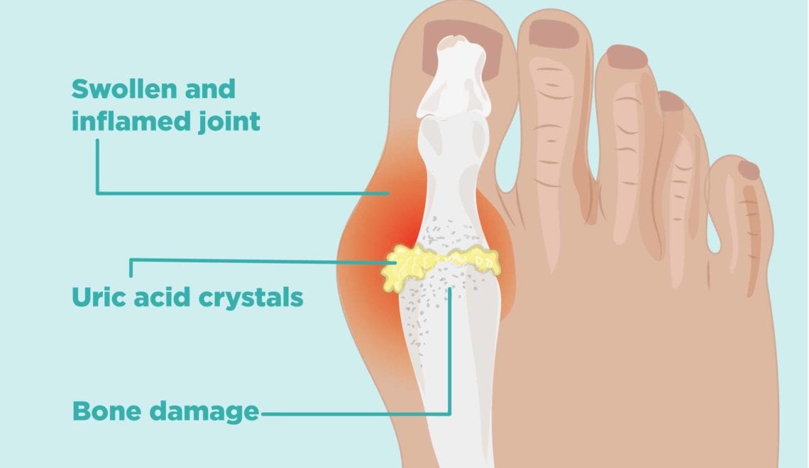 How Gout Causes Bone Damage