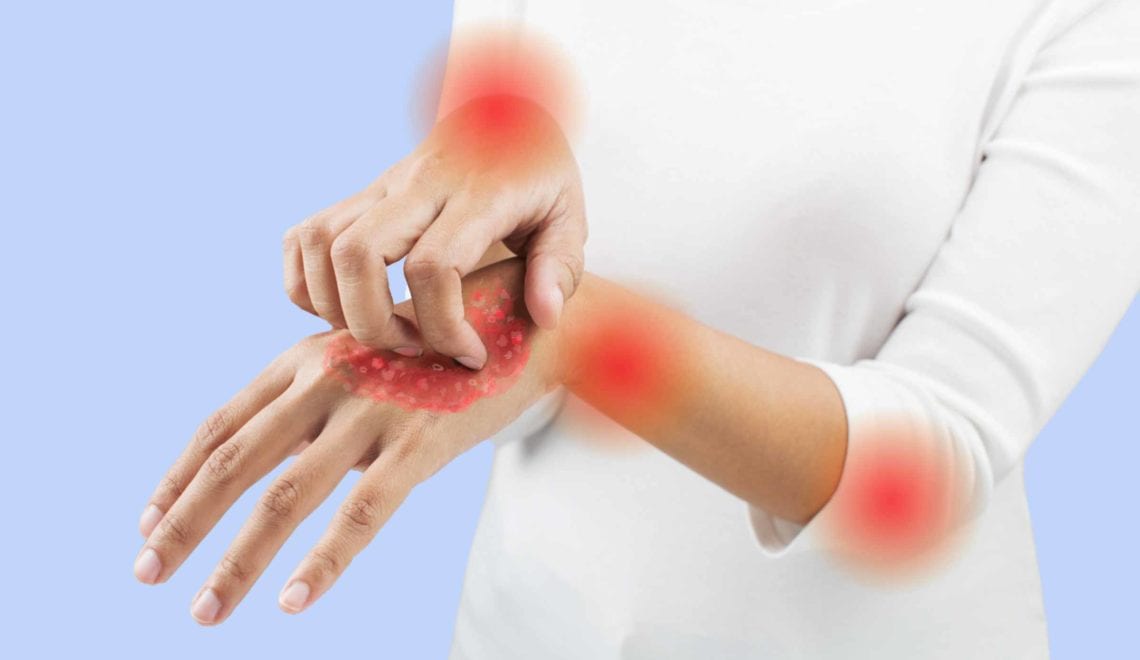 How to Prevent Psoriatic Arthritis