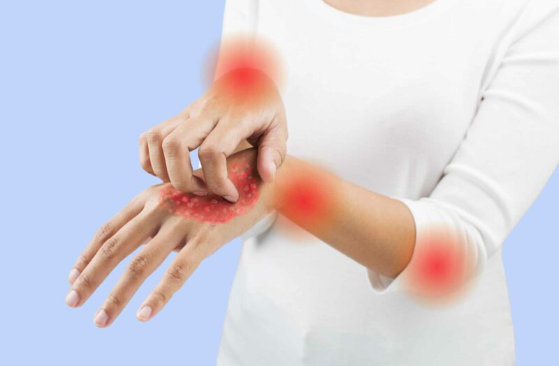 How to Prevent Psoriatic Arthritis