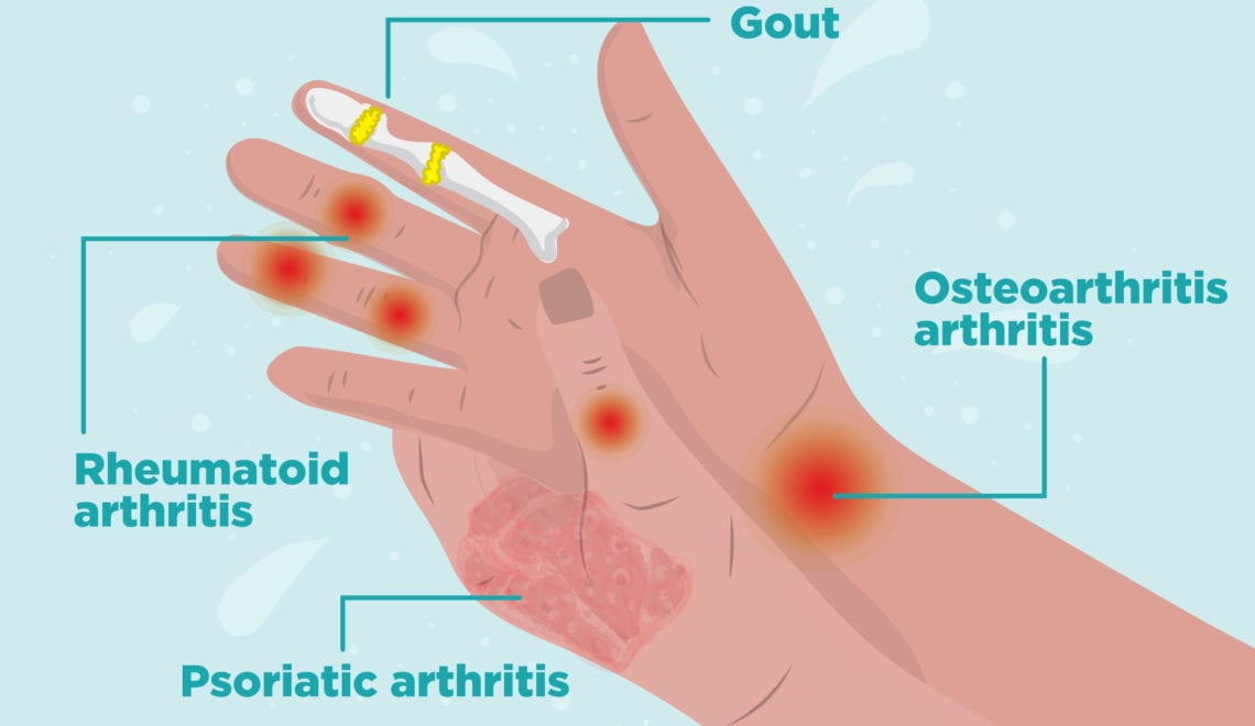 Types of Arthritis in Hands