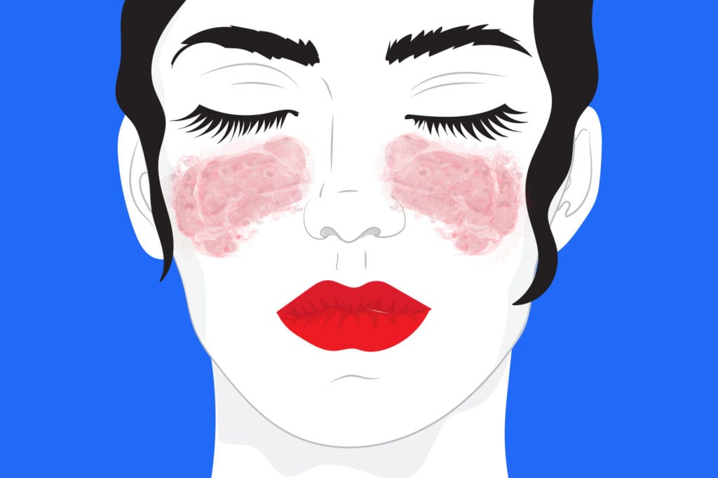 Illustration of a woman with light skin and patches of red on the cheeks and under the eyes