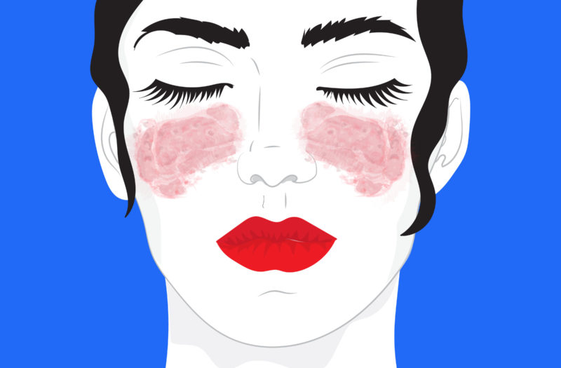 Illustration of a woman with light skin and patches of red on the cheeks and under the eyes