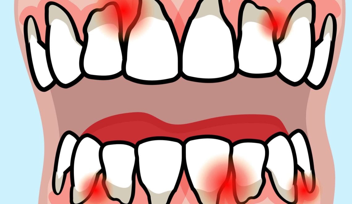 Rheumatoid Arthritis and Gum Disease