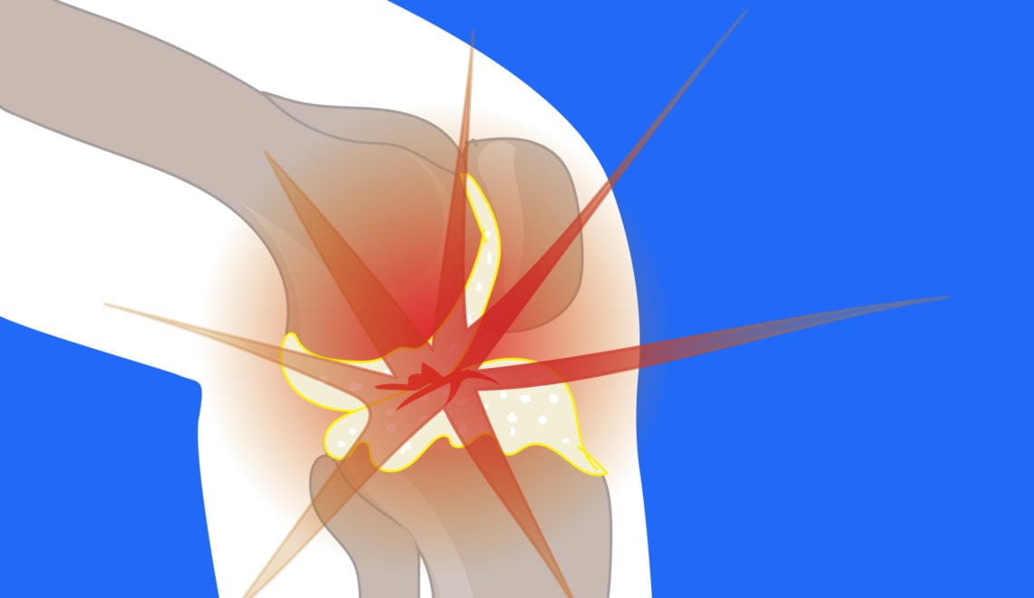 Knee Osteoarthritis