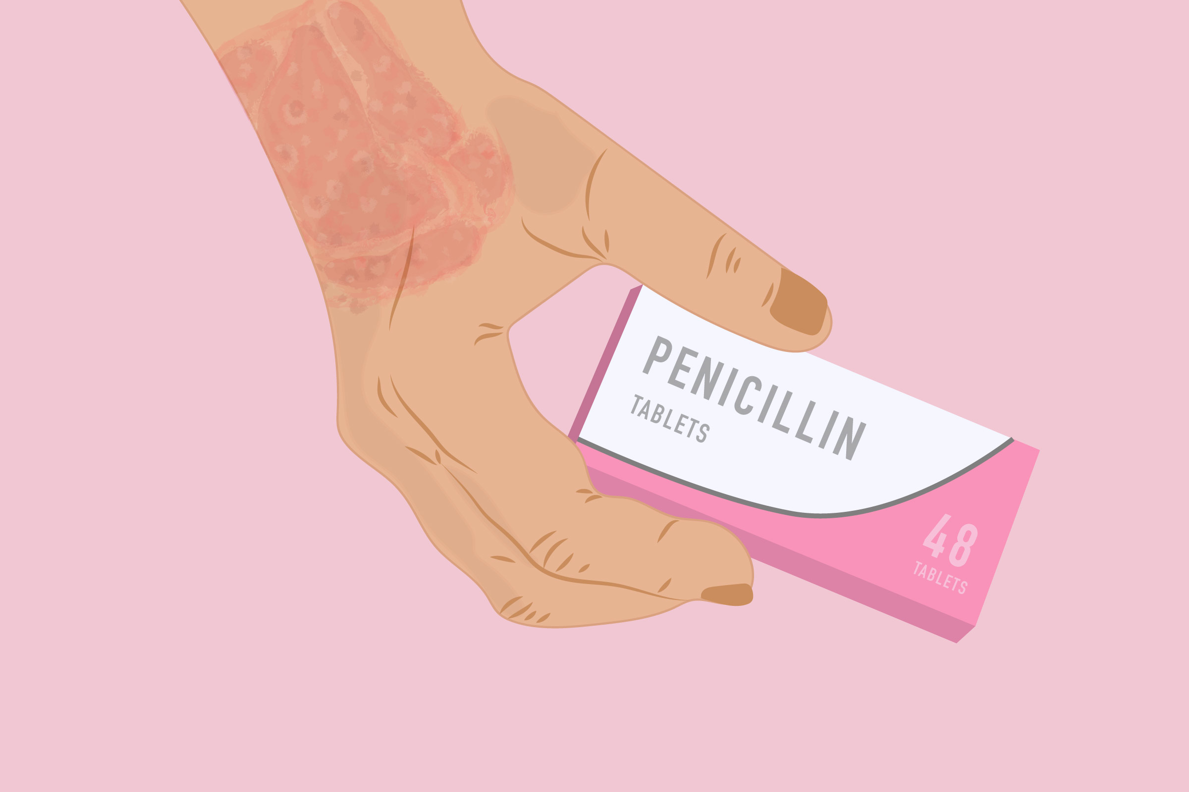 amoxicillin allergy