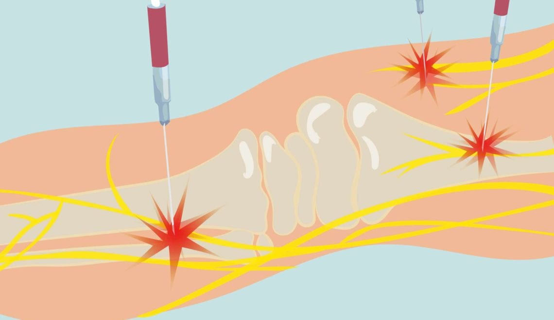 Radiofrequency Ablation for Arthritis