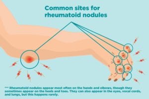 Common sites for rheumatoid nodules on the hand and elbow.