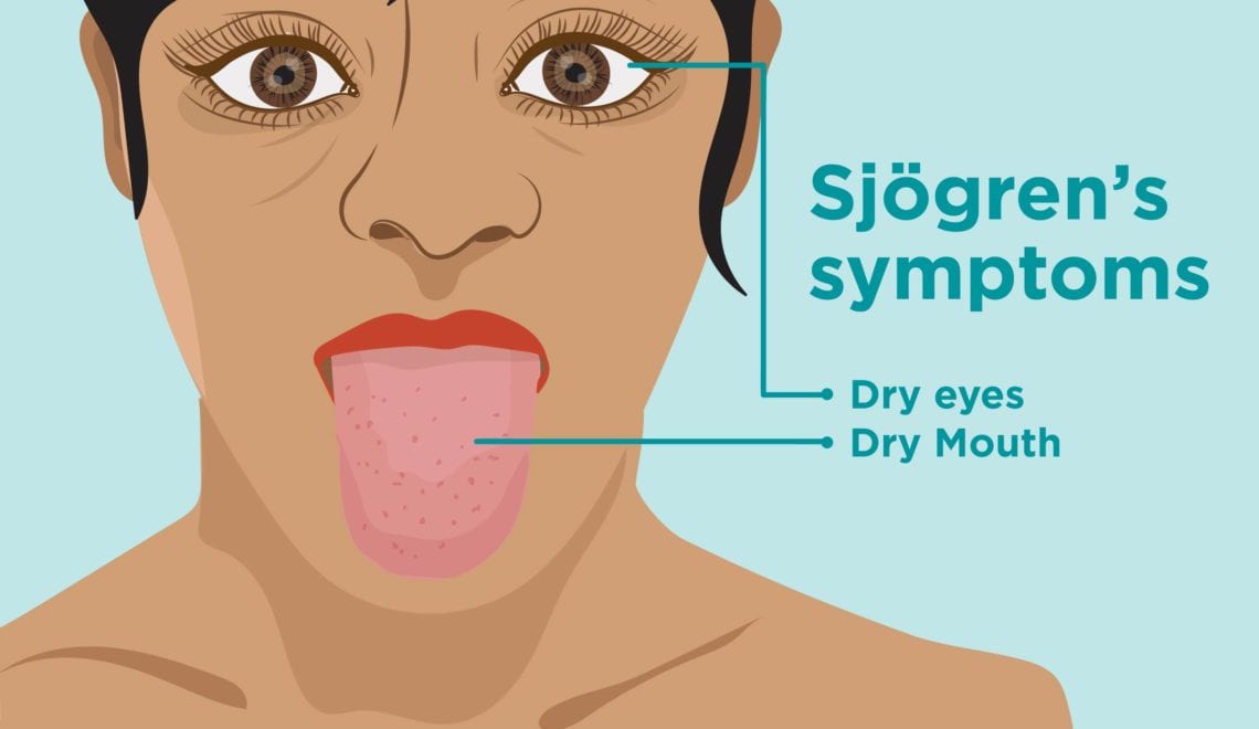 Sjogren's Disease Symptoms