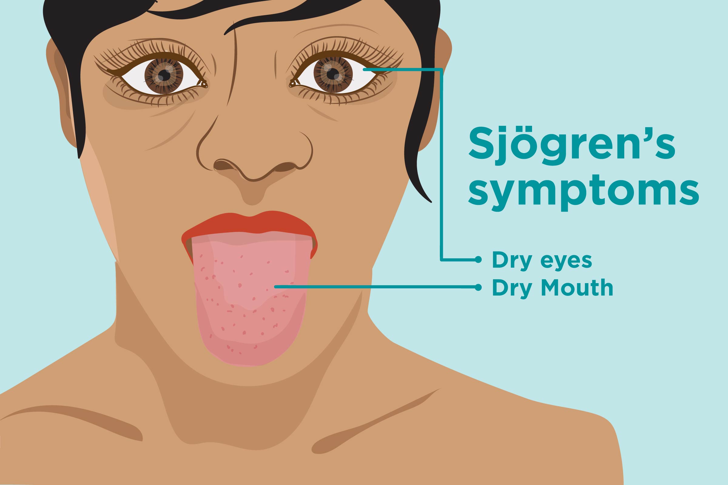 10 Symptoms of Sjögrenʼs syndrome You Should Never Ignore