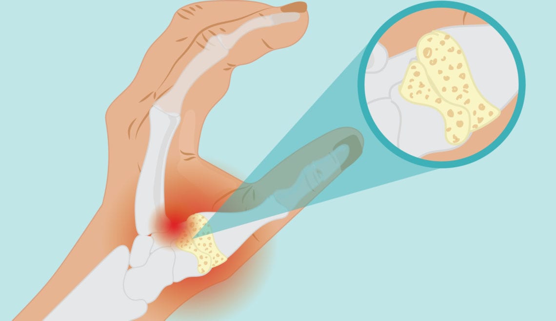 Basal Joint Arthritis