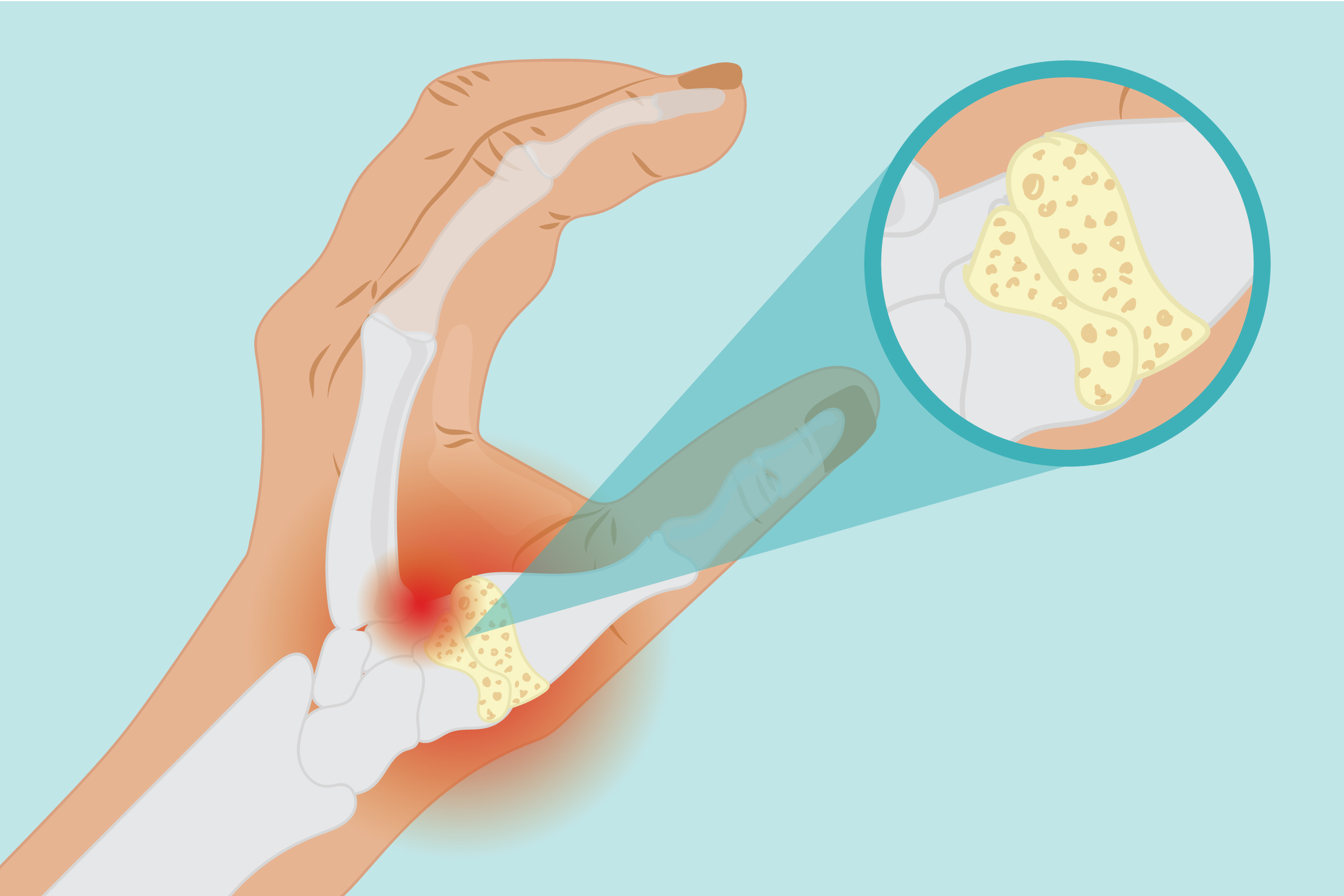 Basal Joint Arthritis Symptoms and Treatment