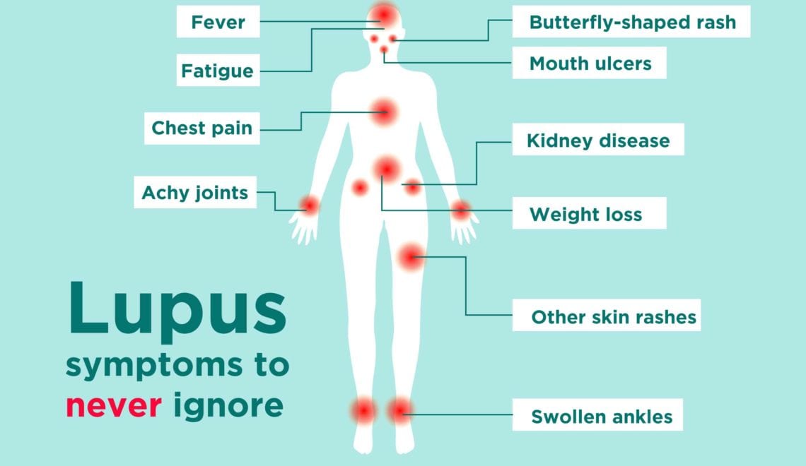 Lupus synptoms infographic