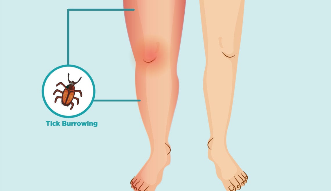 Illustration showing where a tick burrows in a person's leg