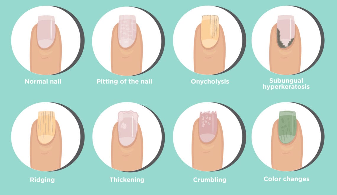 Cartoon shows the difference between a normal nail, pitting, onycholusis, subungual hyperkeratosis, ridging, thickening, crumbling and color changes