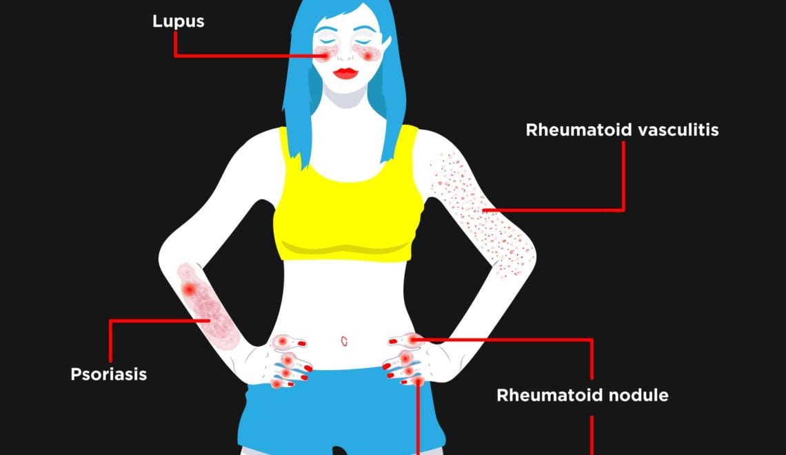 Woman with four different rheumatoid arthritis rashes