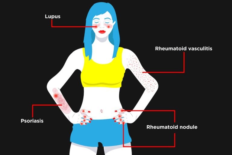 Rheumatoid Arthritis Rashes Causes Treatment Creakyjoints