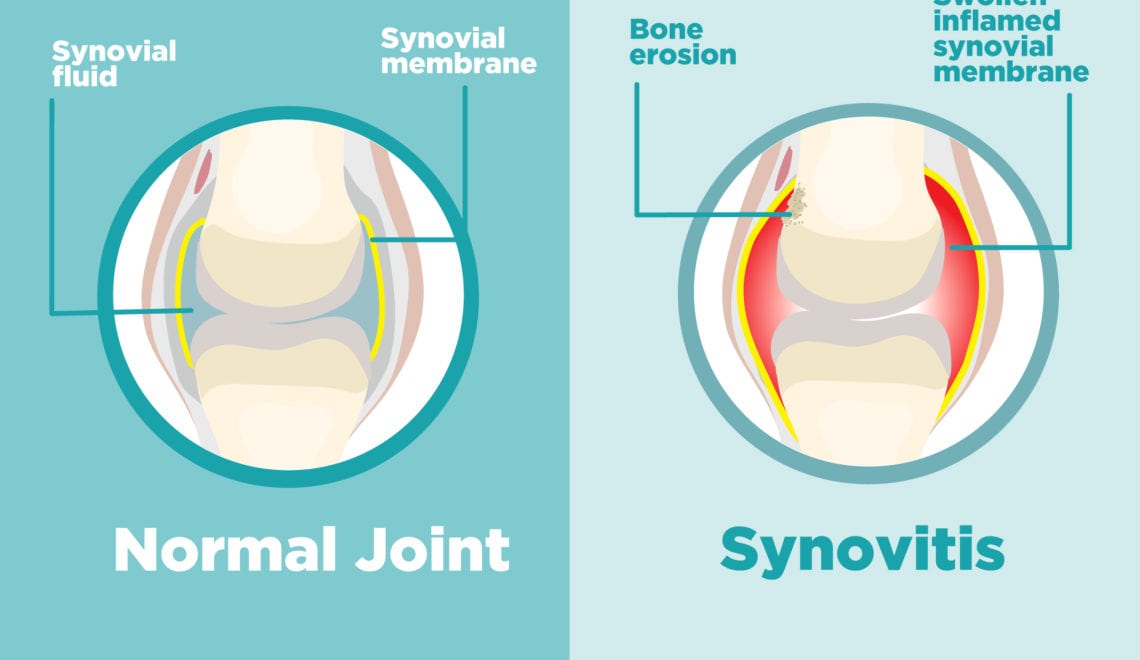 Synovitis Graphic