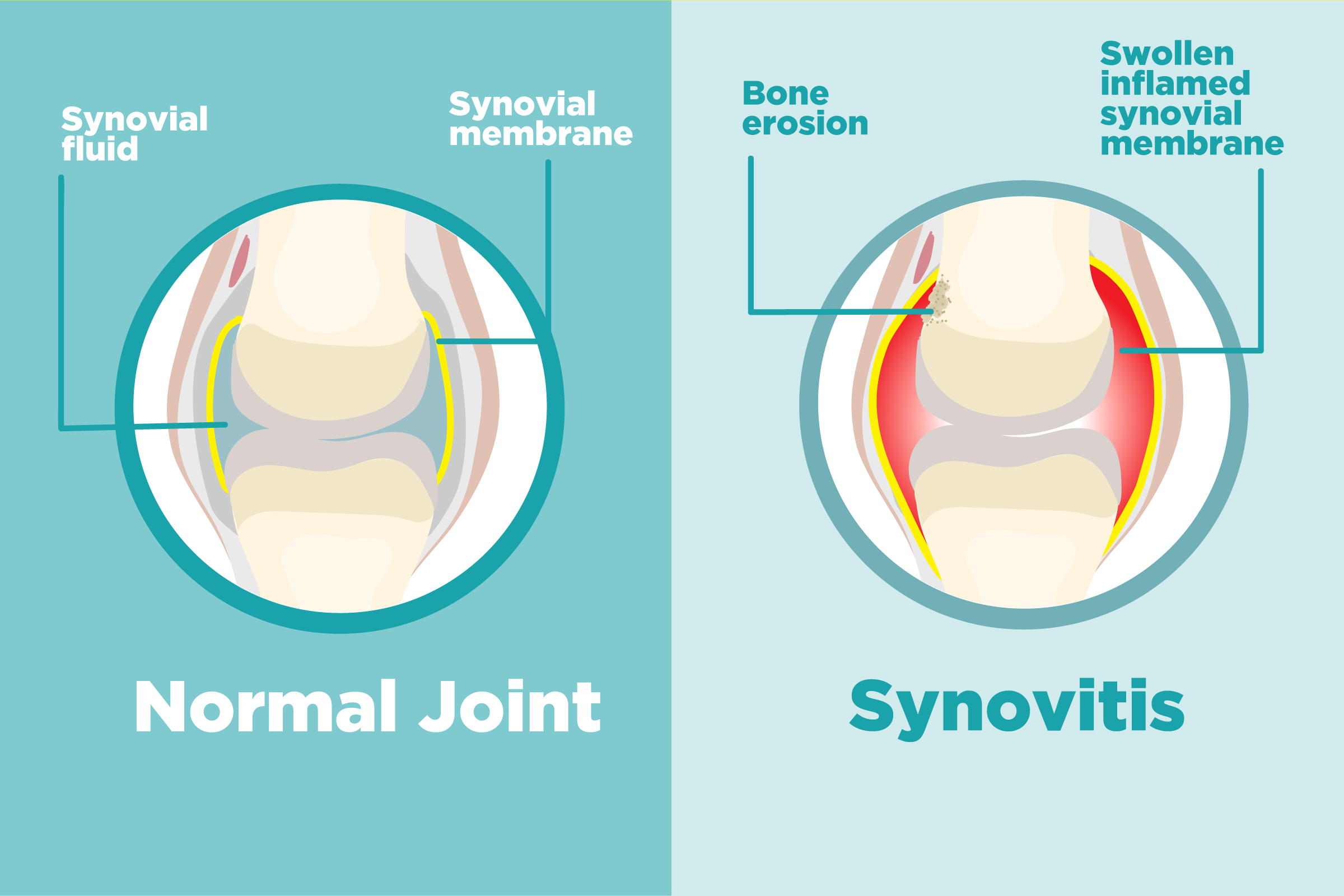 synovitis arthrosis kezelés