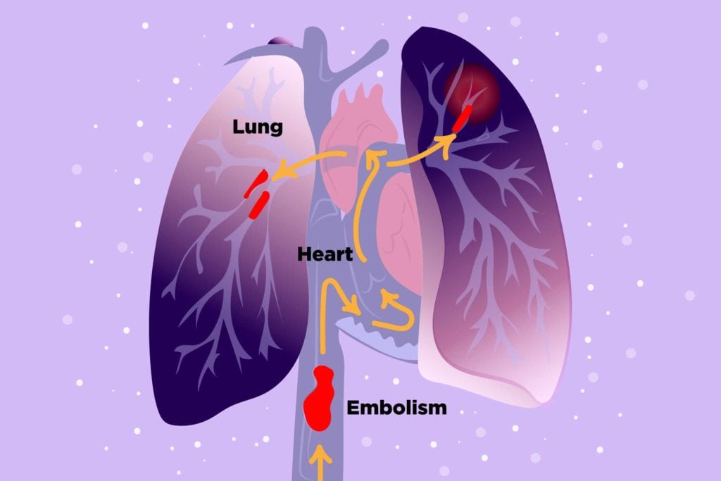 Scientists Evaluate Biomarkers to Predict Blood Clots in People with Lupus