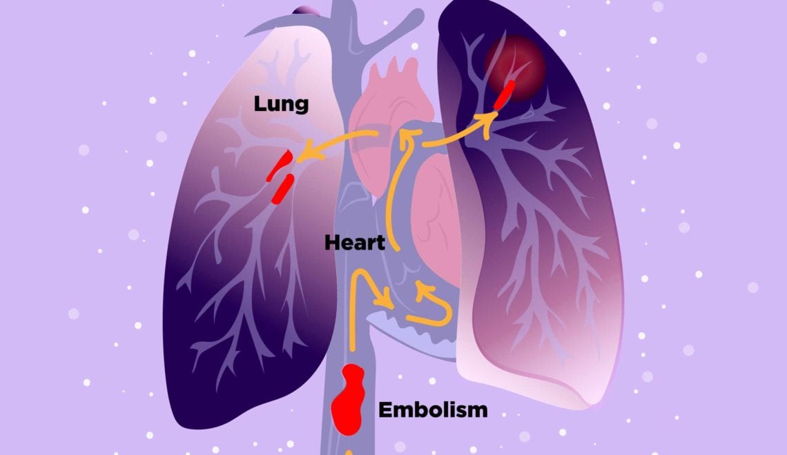 Embolism and JAK Inhibitors Image