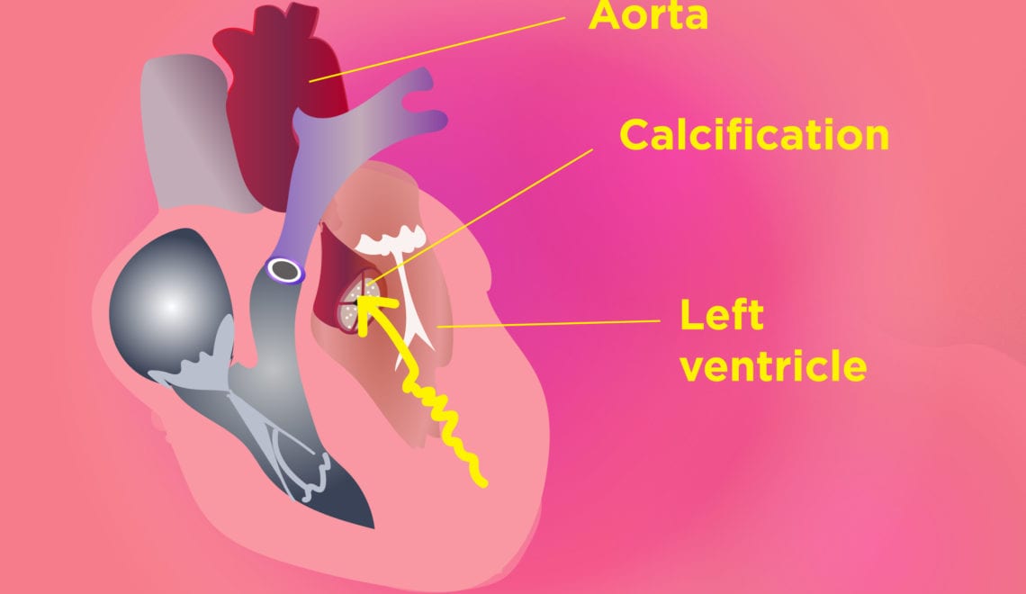 Aortic Valve Calcification