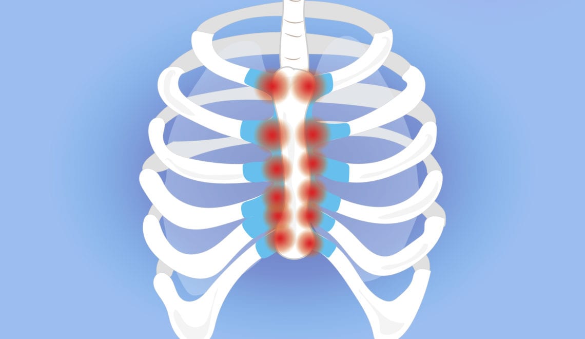 Costochondritis and Arthritis