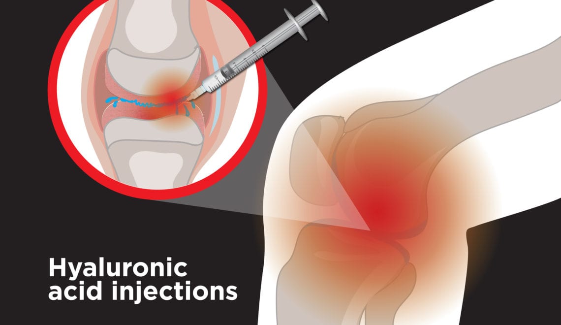 Hyaluronic Acid Injections for Arthritis