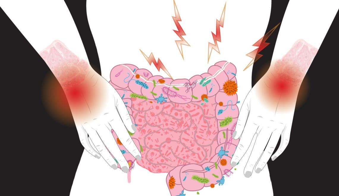 Lupus and Bacteria in the Gut