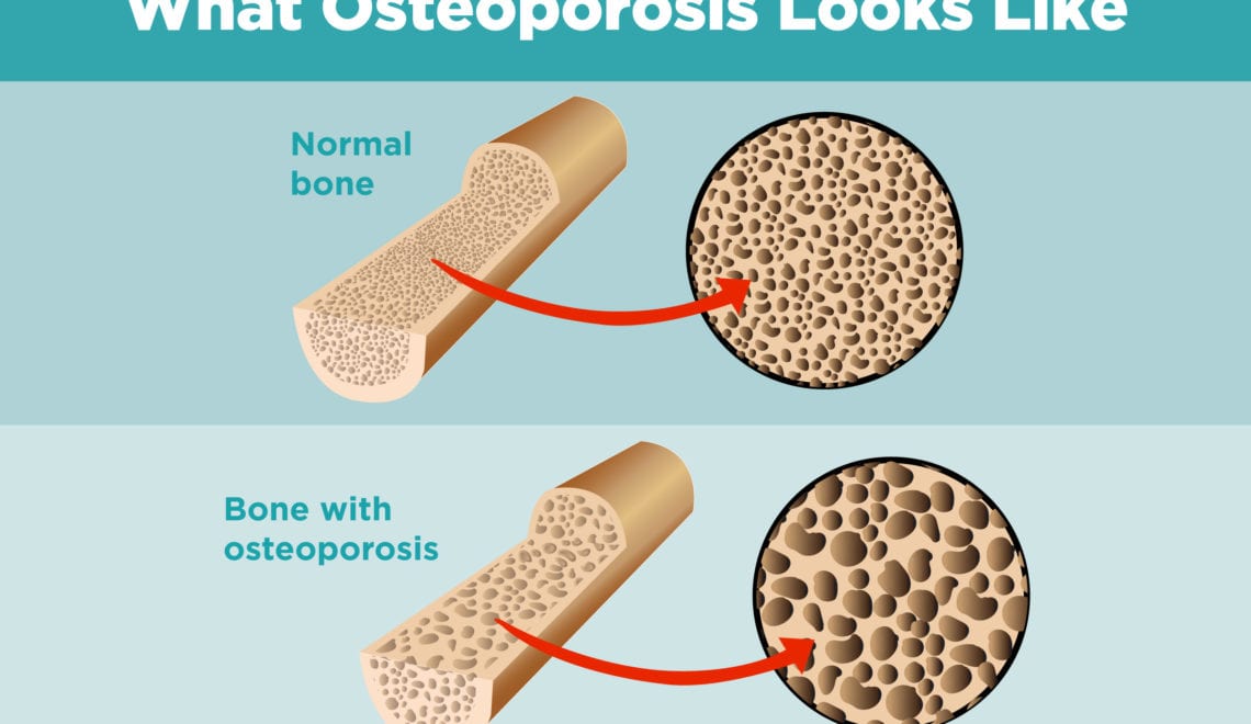 Osteoporosis and Arthritis Graphic