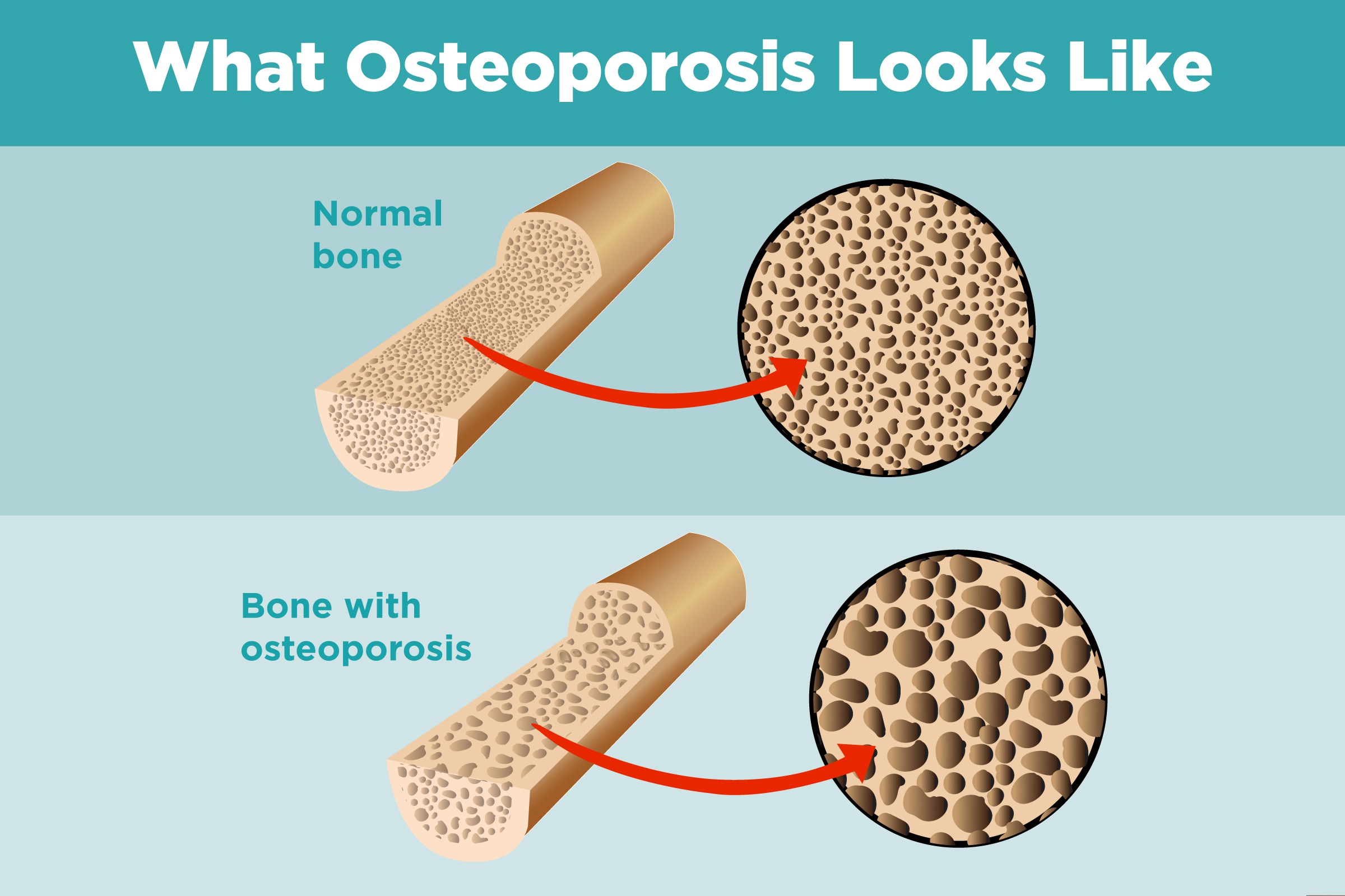 Alimentos prohibidos para osteoporosis