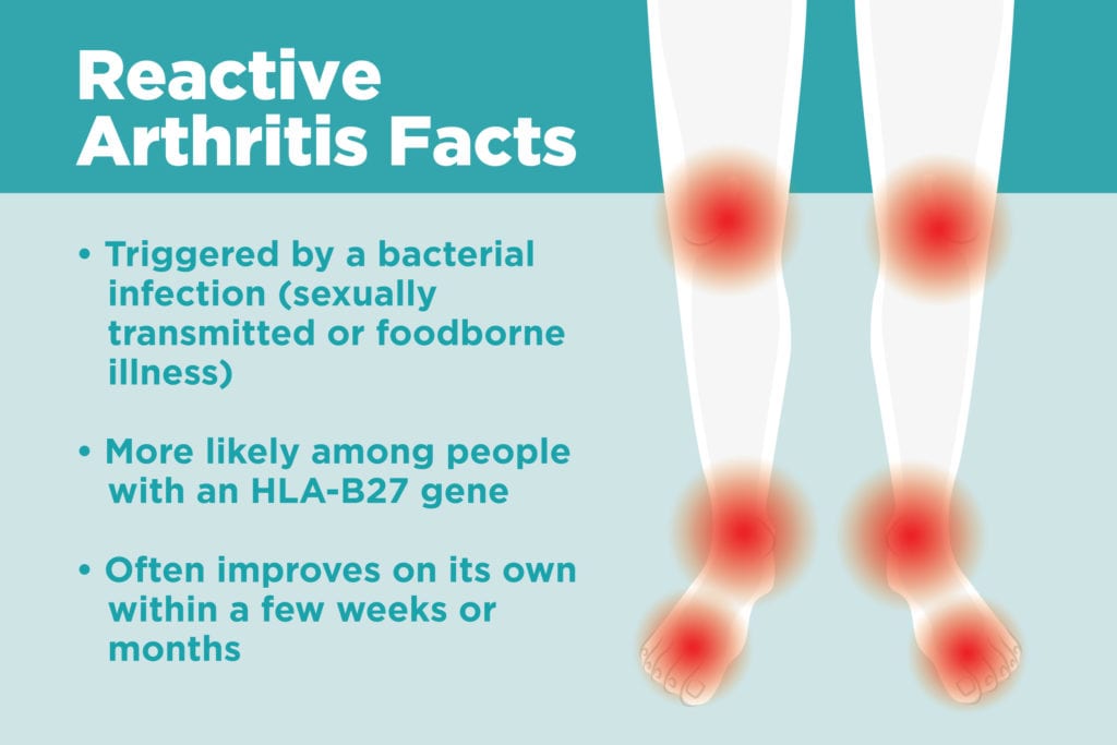 What Is Reactive Arthritis? Understanding Symptoms, Causes, and ...