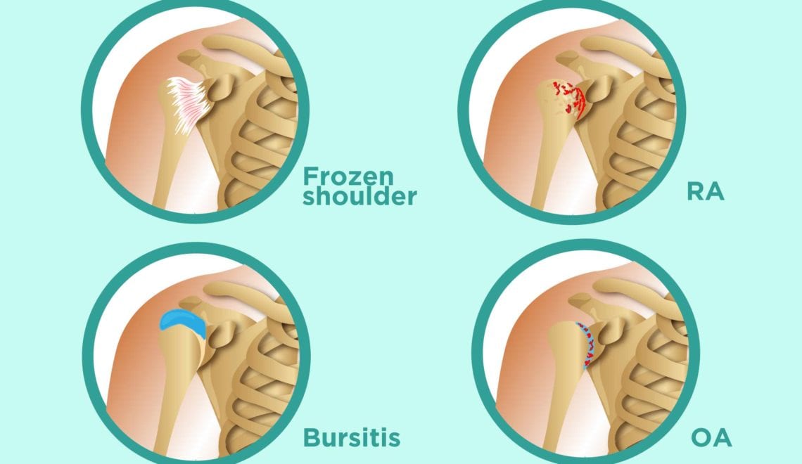 Shoulder Pain and Arthritis