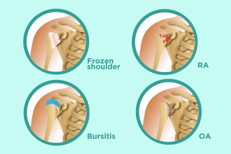 Arthritis in shoulders symptoms types of shoulder arthritis