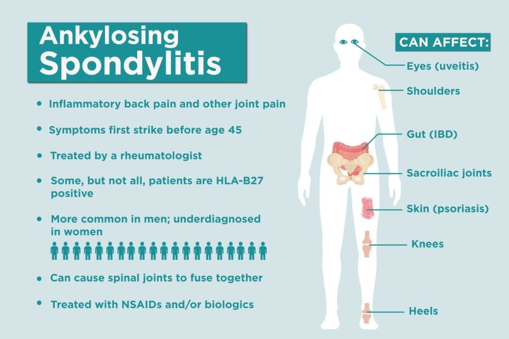 Ankylosing Spondylitis Symptoms And Signs