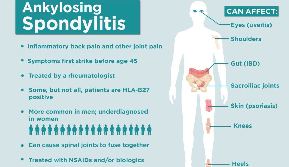 Ankylosing Spondylitis Facts